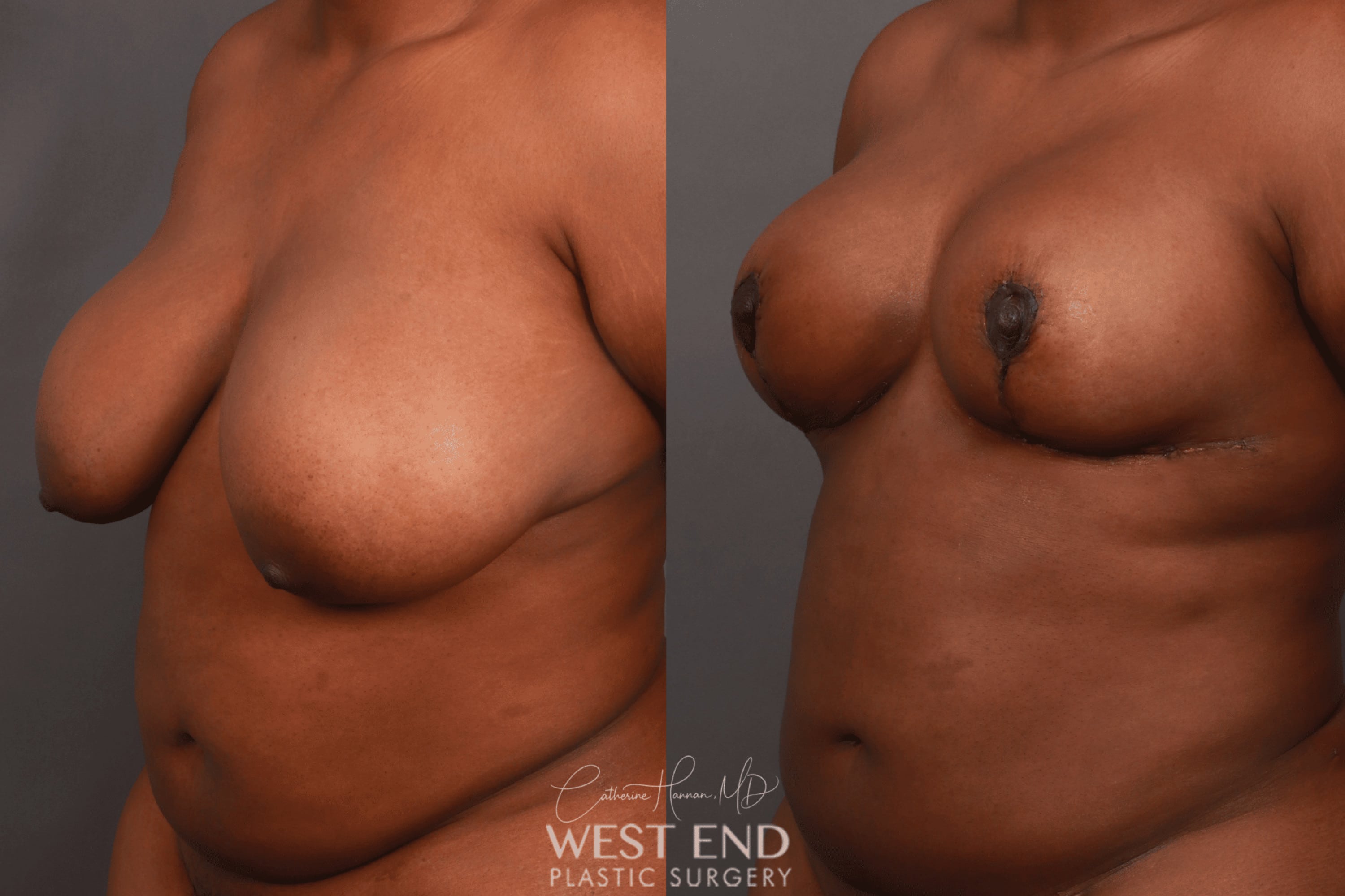 Breast Reduction (5 Days Post-Op)