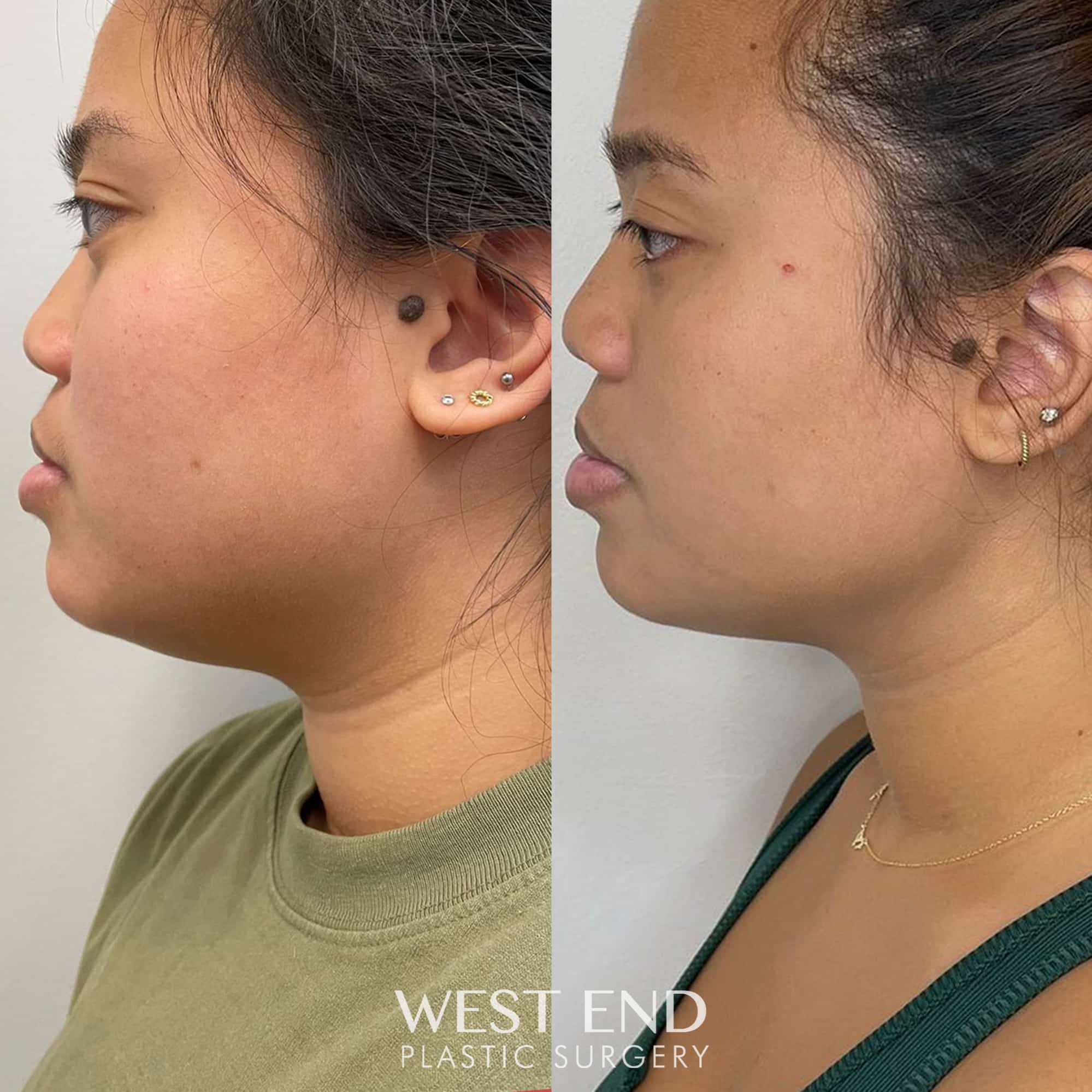 Kybella