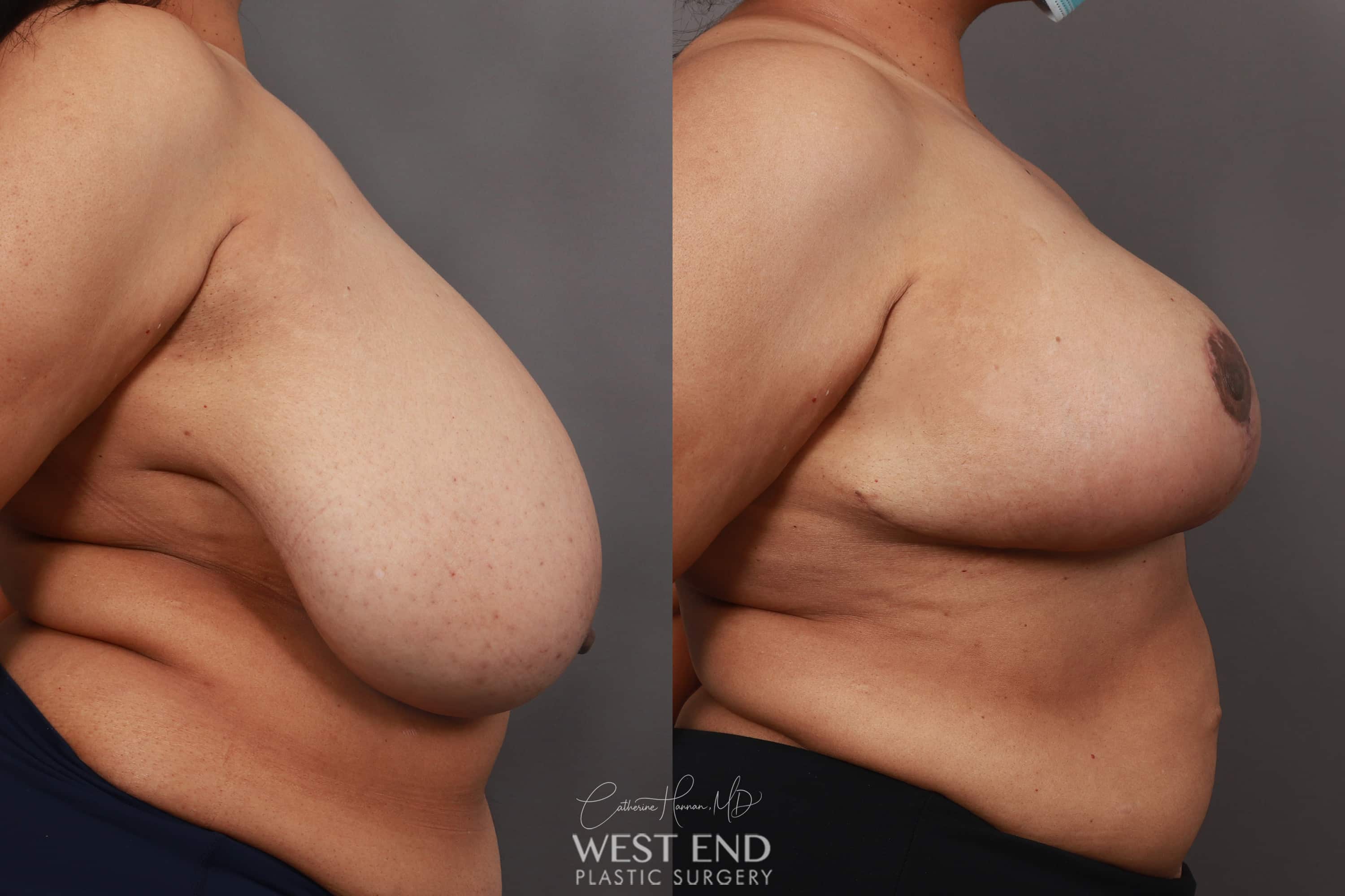 Breast Reduction