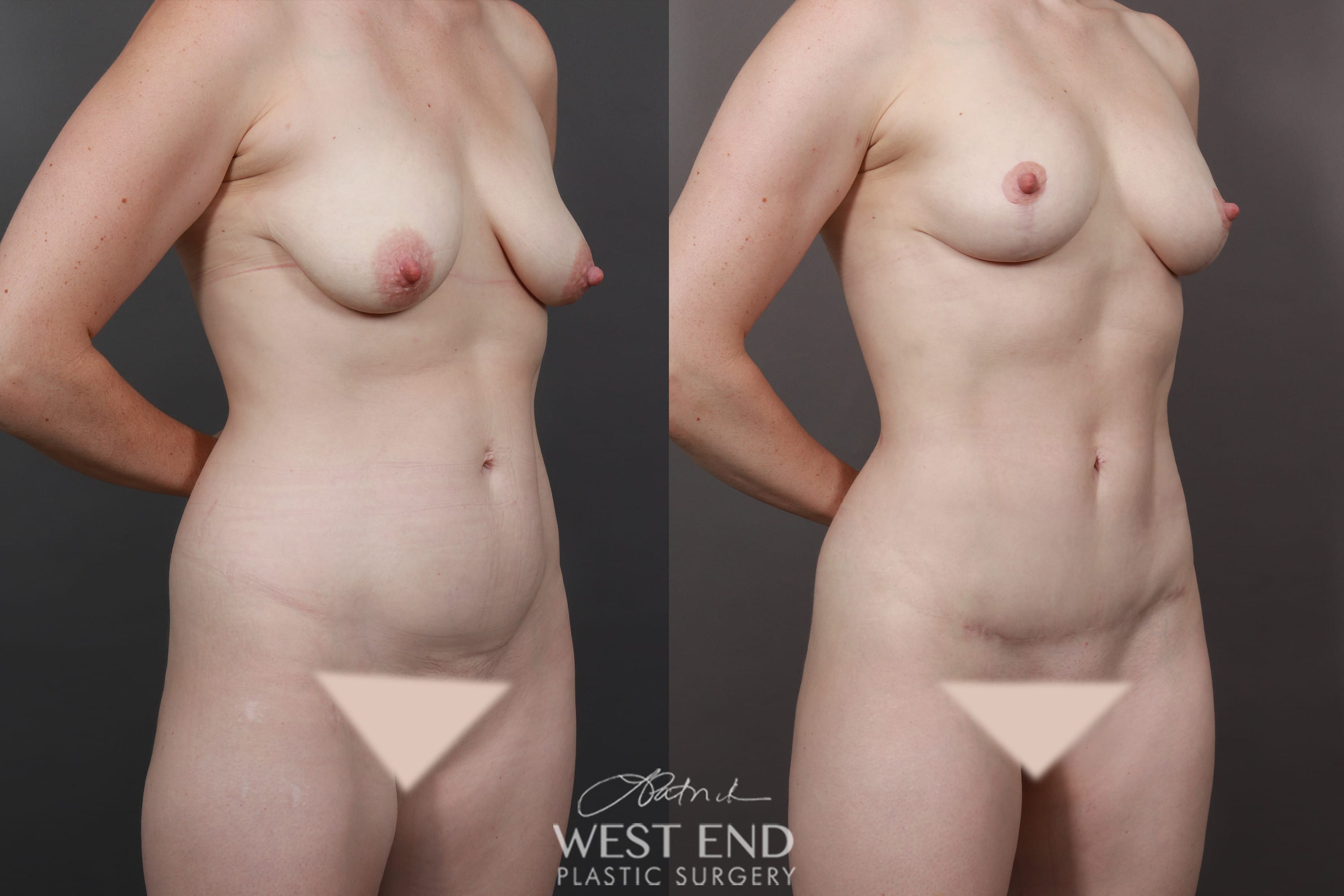 Mommy Makeover (Mini Tummy Tuck, Liposuction, & Breast Lift with Fat Grafting)